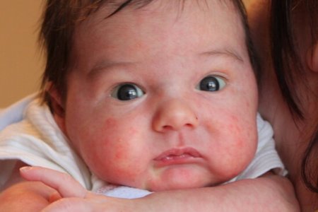 Фото - Младенцы, которые получают препараты для снижения желудочной кислотности, чаще зарабатывают аллергию в детском возрасте.