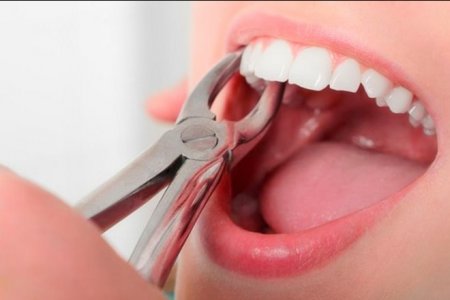 Фото - Как ускорить процесс заживления после удаления зуба